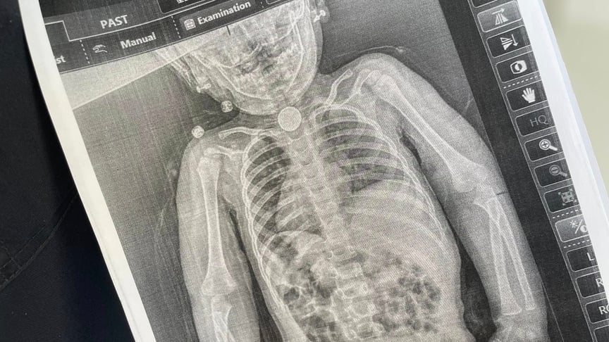 Україночка 112 Маленька героїня: як львівські лікарі врятували дворічну дівчинку, що три місяці жила з небезпечним…